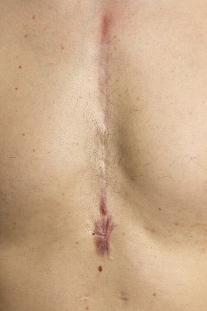 scar on chest